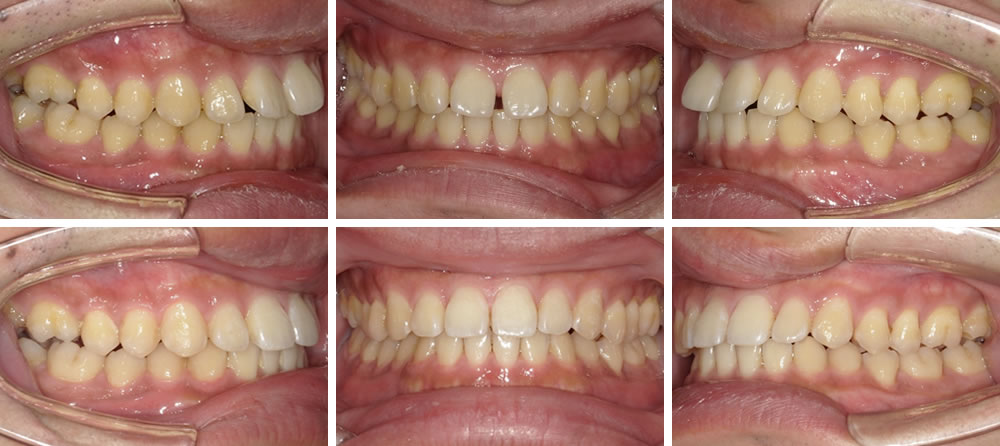 部分矯正すきっ歯の矯正治療例（30代男性・治療期間6ヵ月）