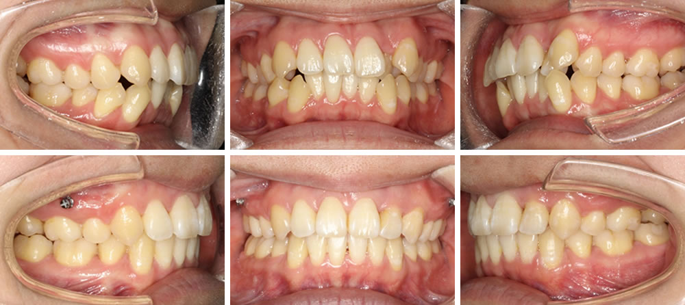 八重歯・叢生(凸凹の歯並び)の矯正治療例（20代女性・治療期間2年）