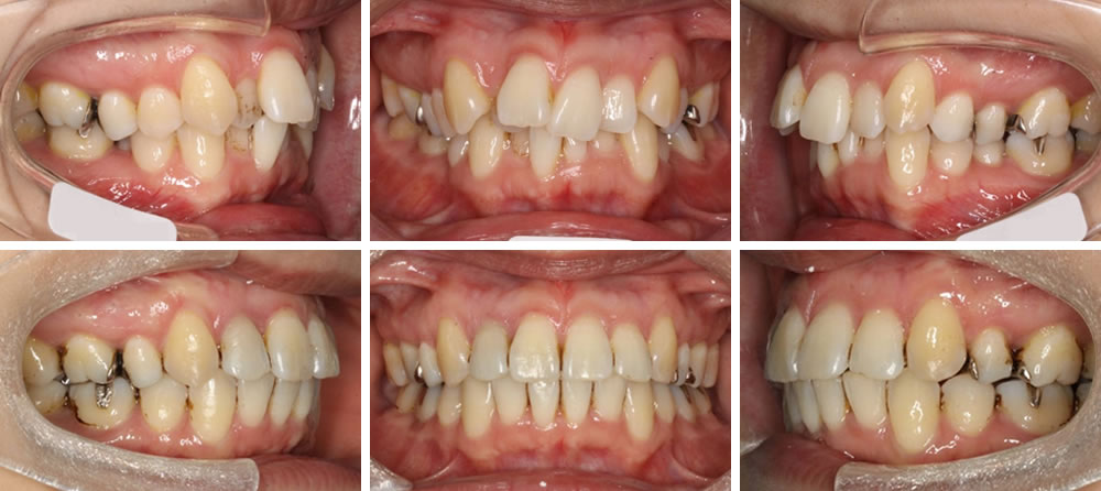 八重歯・叢生(凸凹の歯並び)の矯正治療例（20代女性・治療期間2年5ヵ月）